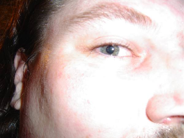 My Eye after Getting Tabasco in it
